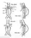 Fig. 10 - Fenestration devices, systems, and methods