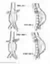 Fig. 12 - Fenestration devices, systems, and methods