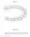 Fig. 11 - Craniotomy closures and plugs