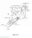 Fig. 02 - INCONTINENCE TREATMENT WITH URETHRAL GUIDE