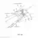 Fig. 03 - INCONTINENCE TREATMENT WITH URETHRAL GUIDE
