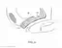 Fig. 08 - INCONTINENCE TREATMENT WITH URETHRAL GUIDE