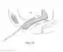 Fig. 12 - INCONTINENCE TREATMENT WITH URETHRAL GUIDE