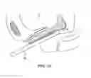 Fig. 13 - INCONTINENCE TREATMENT WITH URETHRAL GUIDE
