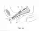 Fig. 15 - INCONTINENCE TREATMENT WITH URETHRAL GUIDE