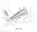Fig. 16 - INCONTINENCE TREATMENT WITH URETHRAL GUIDE