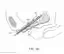 Fig. 17 - INCONTINENCE TREATMENT WITH URETHRAL GUIDE