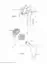 Fig. 02 - Hip Prosthesis With Monoblock Ceramic Acetabular Cup