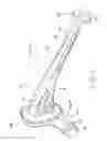 Fig. 04 - PROSTHETIC HIP IMPLANTS