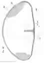 Fig. 06 - Method of formation of a medical implant