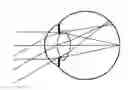 Fig. 01 - Device for asymmetrical refractive optical correction in the peripheral retina for controlling the progression of myopia