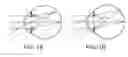 Fig. 02 - Device for asymmetrical refractive optical correction in the peripheral retina for controlling the progression of myopia