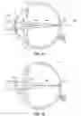 Fig. 02 - PUPIL DEPENDENT DIFFRACTIVE LENS FOR NEAR, INTERMEDIATE, AND FAR VISION