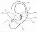 Fig. 01 - Hearing device with a vent extension and method for manufacturing such a hearing device