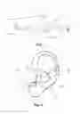 Fig. 02 - Hearing device with a vent extension and method for manufacturing such a hearing device