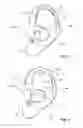 Fig. 03 - Hearing device with a vent extension and method for manufacturing such a hearing device
