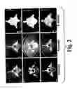 Fig. 03 - Highly-mineralized osteogenic sponge compositions and uses thereof