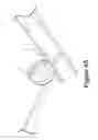 Fig. 35 - CELL COATED IMPLANTABLE DEVICE