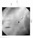 Fig. 16 - Radiopaque cannula marker