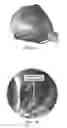 Fig. 02 - Implantable driver with non-invasive transmural powering device for cardiac assist and combined assist and support devices