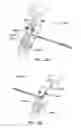 Fig. 13 - Device and method for connecting a blood pump without trapping air bubbles