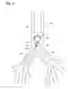 Fig. 05 - Systems and methods for impairing smooth muscle tissue function