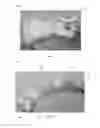 Fig. 02 - CERVICAL COLLAR