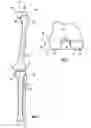 Fig. 02 - POSITIONING GUIDE AND A FEMUR BONE CUTTING GUIDE SYSTEM