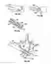 Fig. 11 - Devices and methods for treating bone