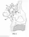 Fig. 04 - BONE FIXATION TENSIONING TOOL AND METHOD