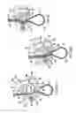 Fig. 06 - BONE FIXATION TENSIONING TOOL AND METHOD