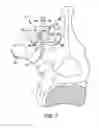 Fig. 07 - BONE FIXATION TENSIONING TOOL AND METHOD