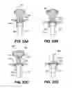 Fig. 35 - Apparatus for treating a portion of a reproductive system and related methods of use