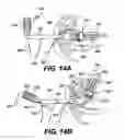 Fig. 16 - Apparatus for treating a portion of a reproductive system and related methods of use
