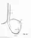 Fig. 74 - Method for fastening a hinged surgical fastener on tissue