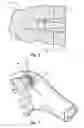 Fig. 04 - Bone anchors with thread pattern optimized for attachment to hard and soft bone tissue