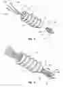 Fig. 05 - Bone anchors with thread pattern optimized for attachment to hard and soft bone tissue