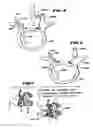 Fig. 04 - Facet arthroplasty devices and methods