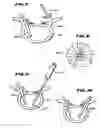 Fig. 05 - Facet arthroplasty devices and methods
