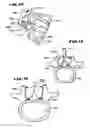 Fig. 07 - Facet arthroplasty devices and methods