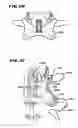 Fig. 09 - Facet arthroplasty devices and methods
