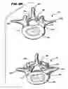 Fig. 13 - Facet arthroplasty devices and methods