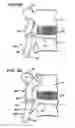 Fig. 15 - Facet arthroplasty devices and methods