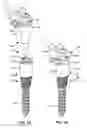 Fig. 02 - LOW PROFILE SPINAL PROSTHESIS INCORPORATING A CANNULATED BONE ANCHOR HAVING A DEFLECTABLE POST AND A COMPOUND SPINAL ROD