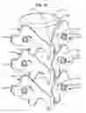 Fig. 04 - LOW PROFILE SPINAL PROSTHESIS INCORPORATING A CANNULATED BONE ANCHOR HAVING A DEFLECTABLE POST AND A COMPOUND SPINAL ROD