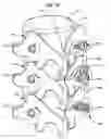 Fig. 05 - LOW PROFILE SPINAL PROSTHESIS INCORPORATING A CANNULATED BONE ANCHOR HAVING A DEFLECTABLE POST AND A COMPOUND SPINAL ROD