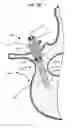 Fig. 10 - LOW PROFILE SPINAL PROSTHESIS INCORPORATING A CANNULATED BONE ANCHOR HAVING A DEFLECTABLE POST AND A COMPOUND SPINAL ROD