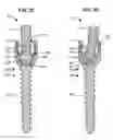 Fig. 12 - LOW PROFILE SPINAL PROSTHESIS INCORPORATING A CANNULATED BONE ANCHOR HAVING A DEFLECTABLE POST AND A COMPOUND SPINAL ROD