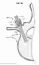 Fig. 13 - LOW PROFILE SPINAL PROSTHESIS INCORPORATING A CANNULATED BONE ANCHOR HAVING A DEFLECTABLE POST AND A COMPOUND SPINAL ROD