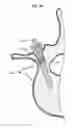 Fig. 14 - LOW PROFILE SPINAL PROSTHESIS INCORPORATING A CANNULATED BONE ANCHOR HAVING A DEFLECTABLE POST AND A COMPOUND SPINAL ROD